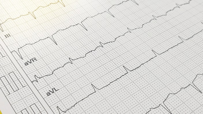 ICU COVID-19 patients 10x more likely to develop cardiac arrhythmia