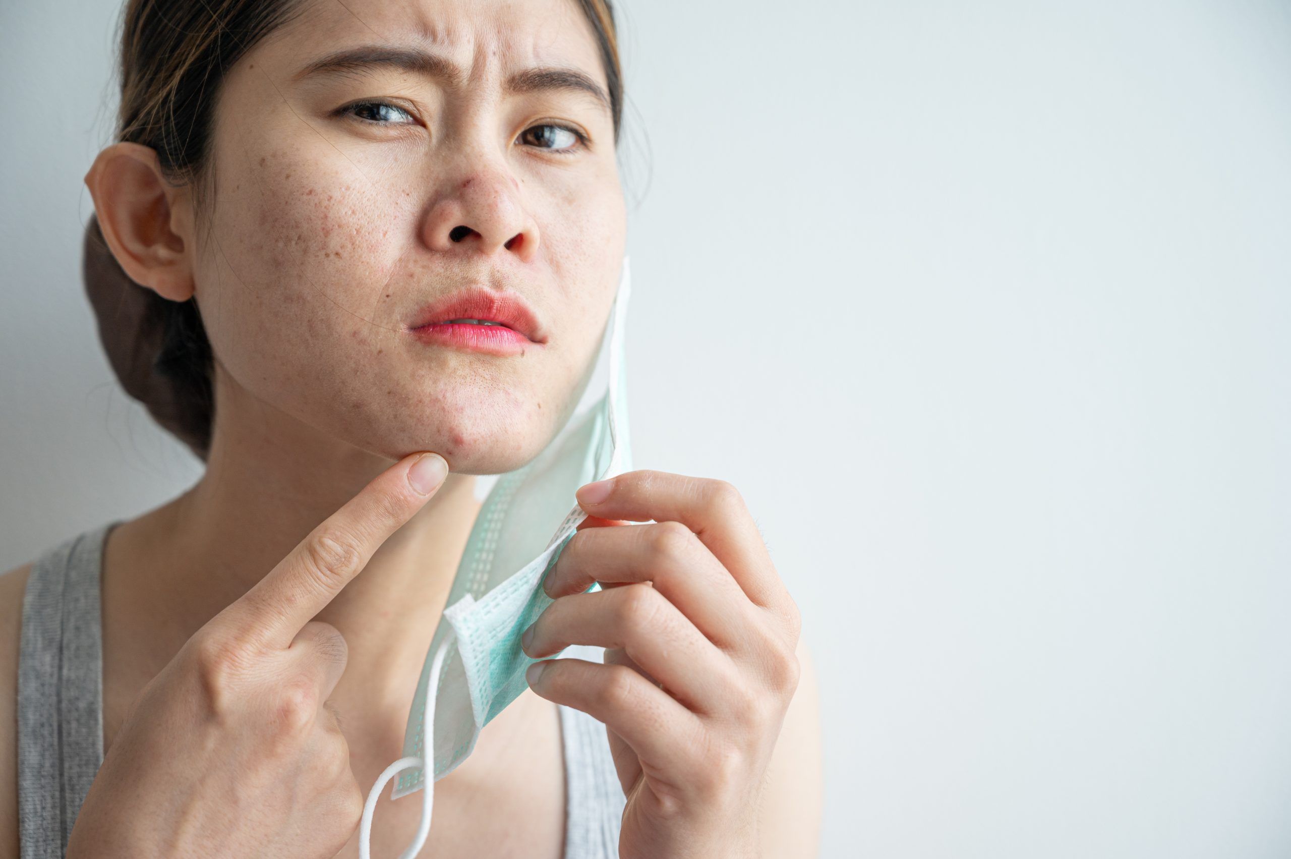 Pimples and other skin irritations are a consequence of mask wearing. Stock/Getty