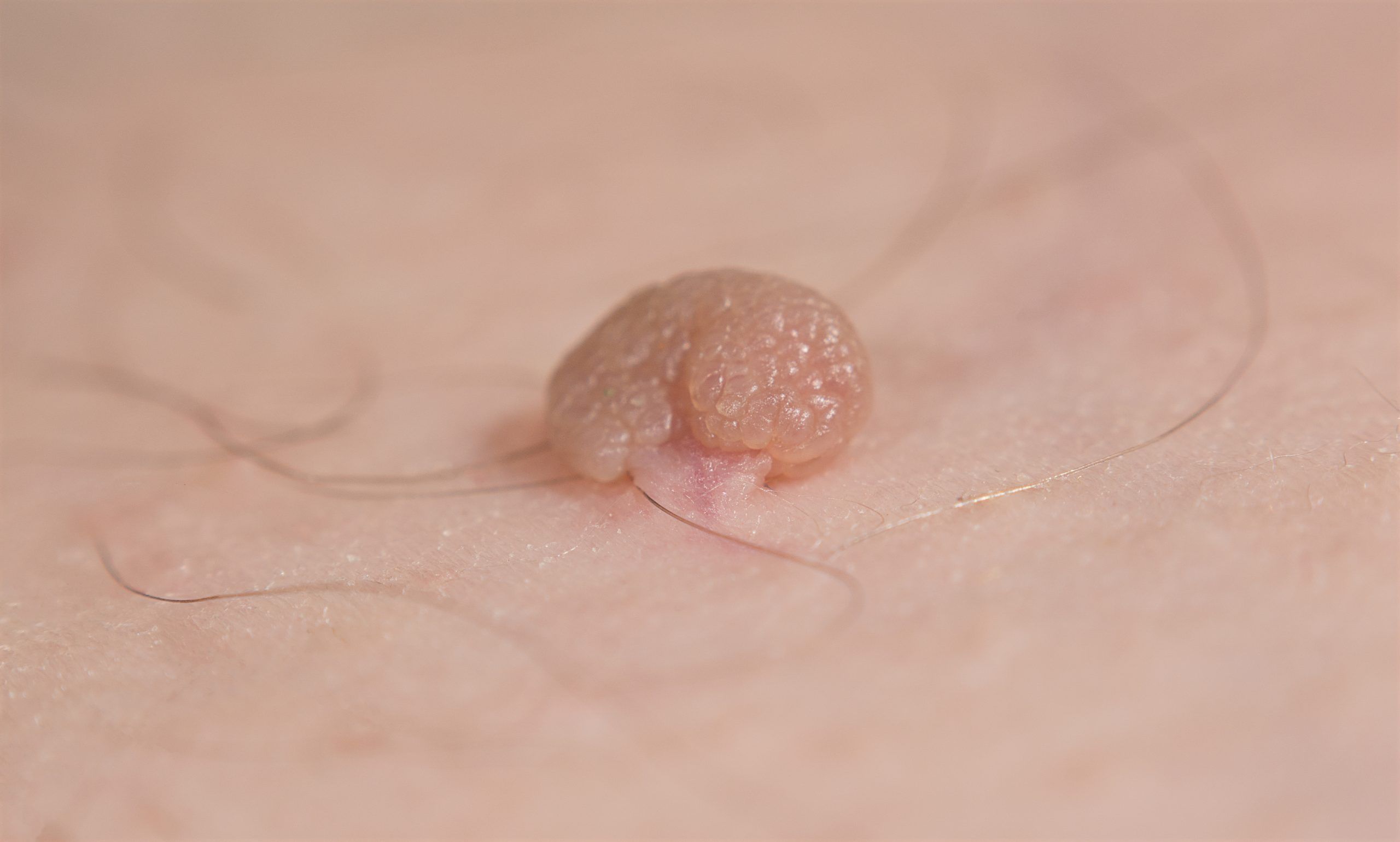 Skin tags can be annoying, but they are usually harmless. Stock/Getty