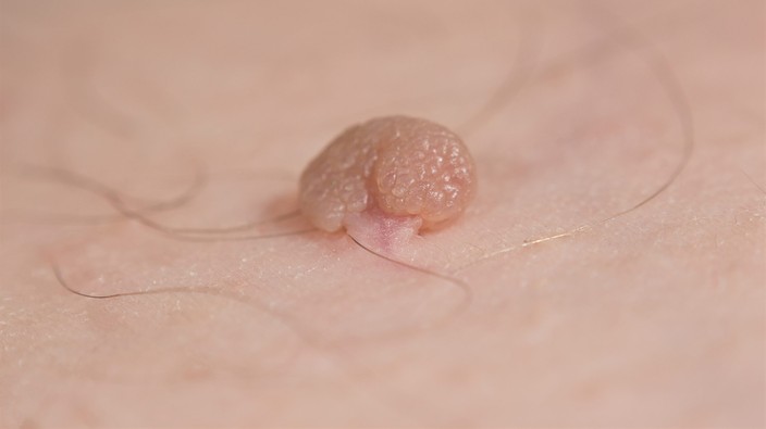 ADVICE: Relative's skin tag is grossing reader out