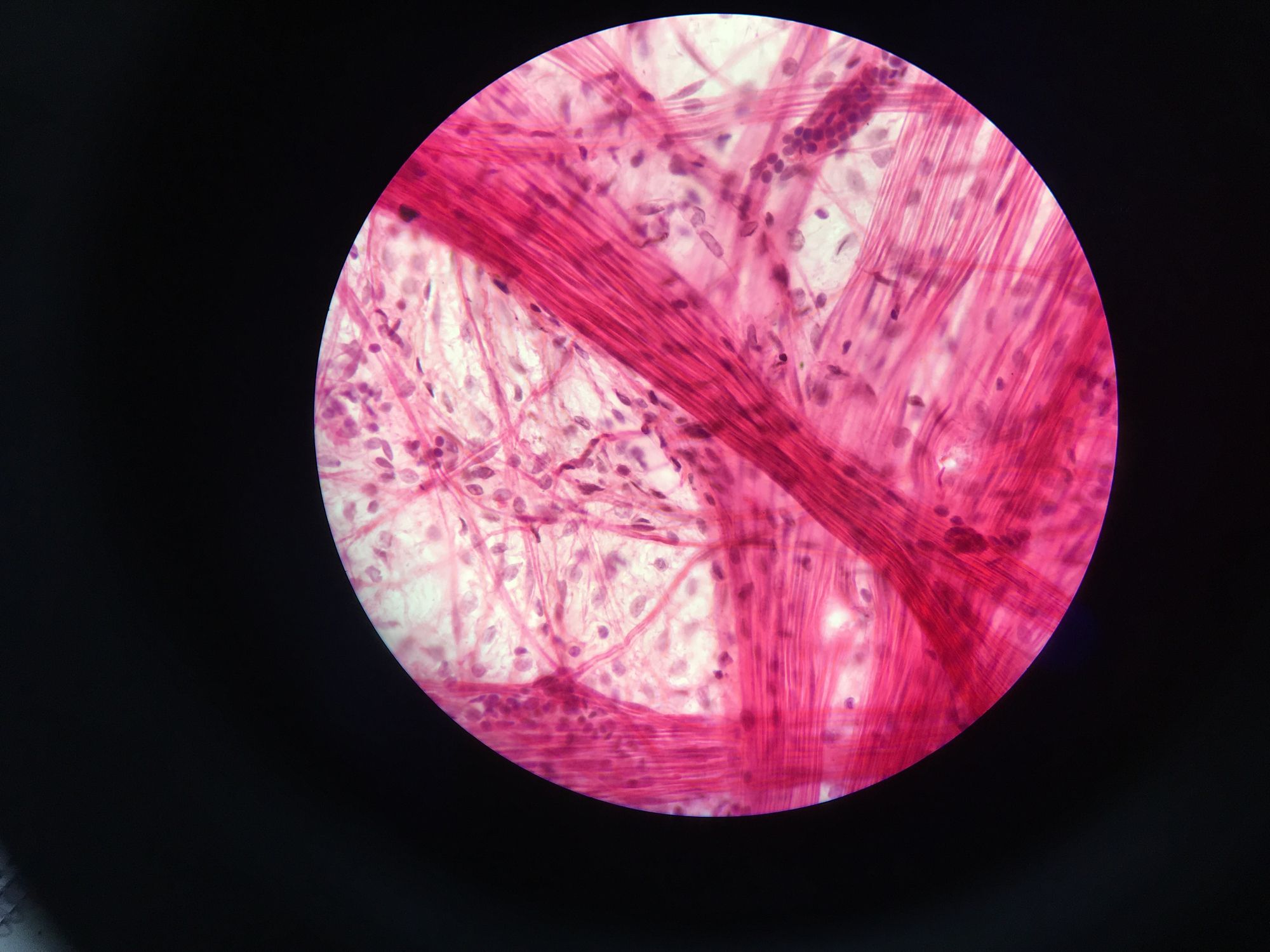 In an in vitro (lab) study, heart muscle cells that were infected with SARS-CoV-2 became damaged and were unable to properly beat because the fibres that help the muscles contract broke apart into small pieces.