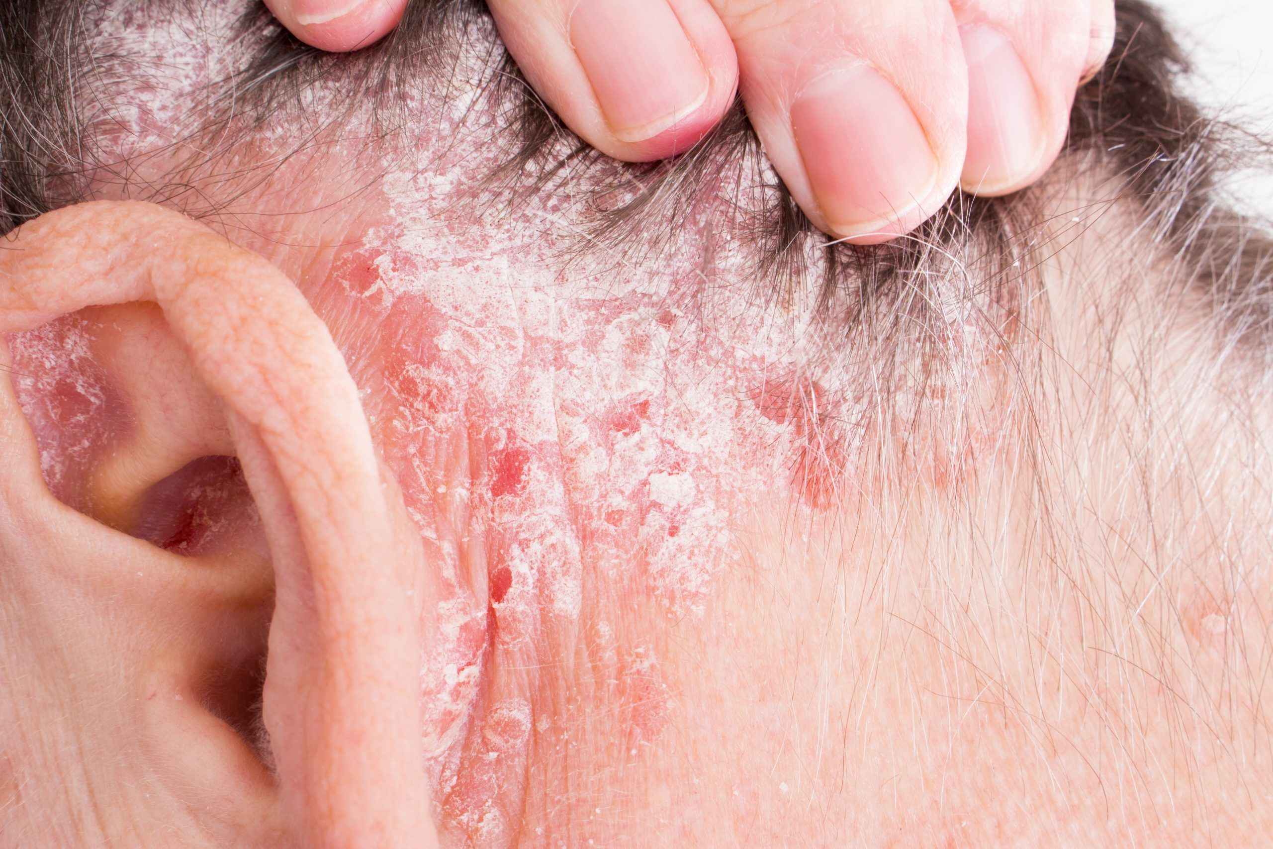 Psoriasis affects more than one million Canadians. GETTY