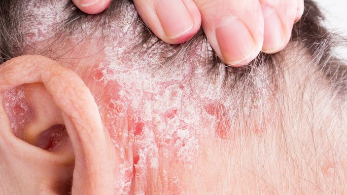 People with psoriasis more likely to consider suicide