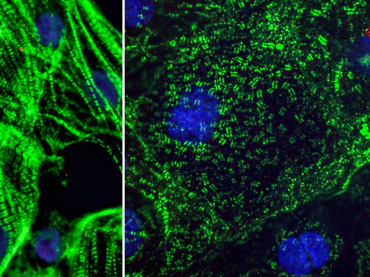  Left: A healthy heart muscle with fibres that help the heart muscles contract. Right: The virus that causes COVID-19 slices these fibres into small pieces and impacting the heart cell’s ability to beat. (Image: Gladstone Institute.)