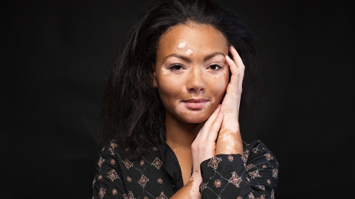 Vitiligo:  SPF, skin health and beauty
