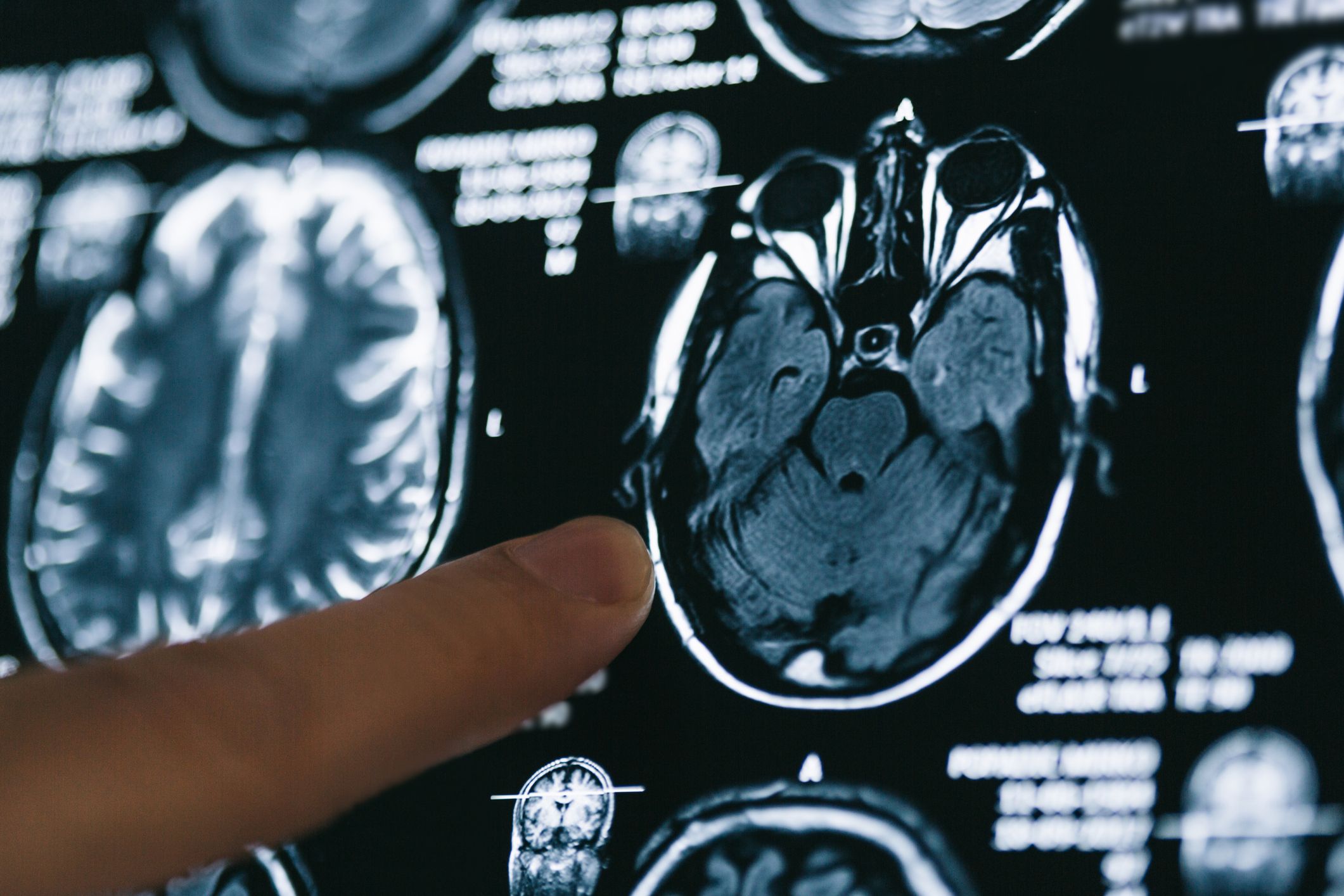 Canadian researchers have a new way to look at glioblastoma.