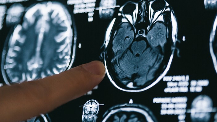 Aggressive brain cancer linked to injury, stroke