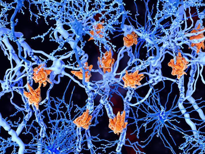 FILE: Multiple sclerosis is a painful disease of the central nervous system in which the body’s immune system mistakenly attacks the myelin sheath that surrounds and protects nerve cells. /
