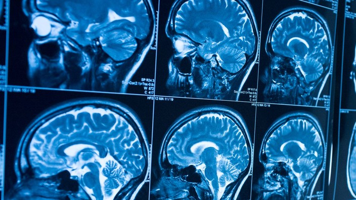 Device shrinks brain tumour in human trial