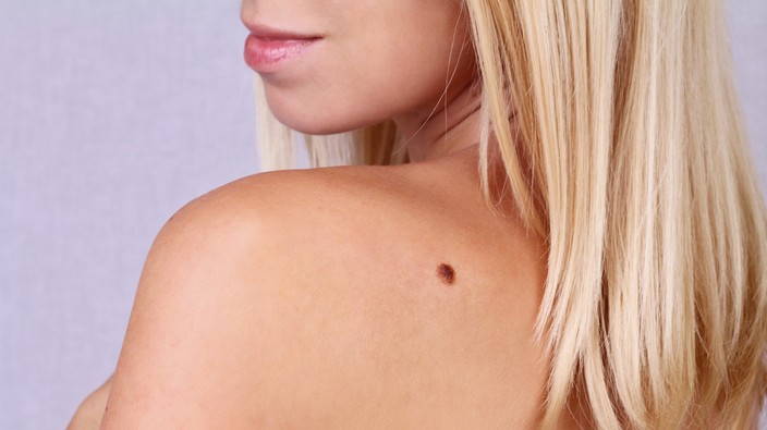 We know more about how moles become melanoma than we did last week