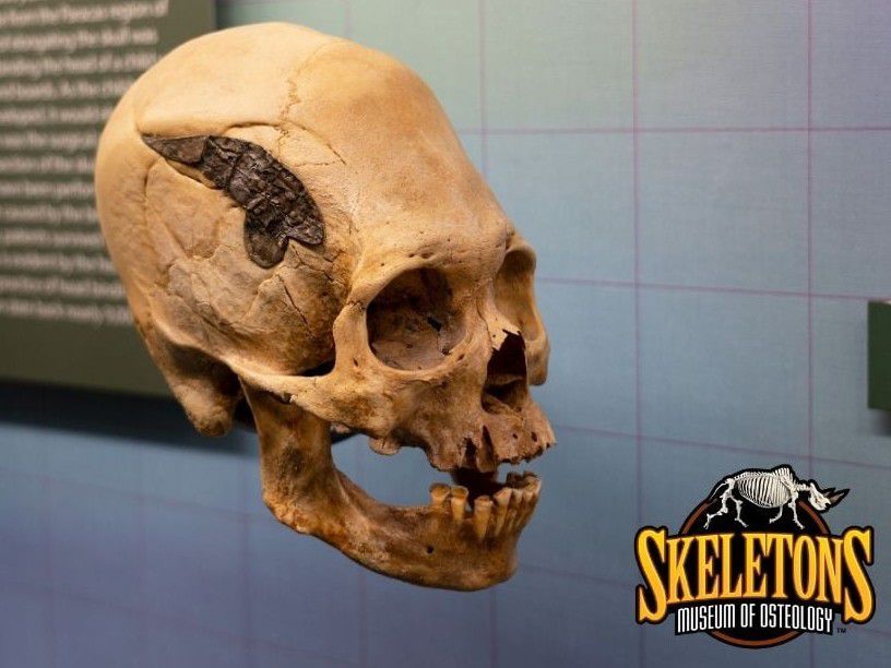 The 2,000-year-old skull is believed to be of a warrior who sustained a serious skull fracture in battle and had surgery to embed a piece of metal to mend the fracture.