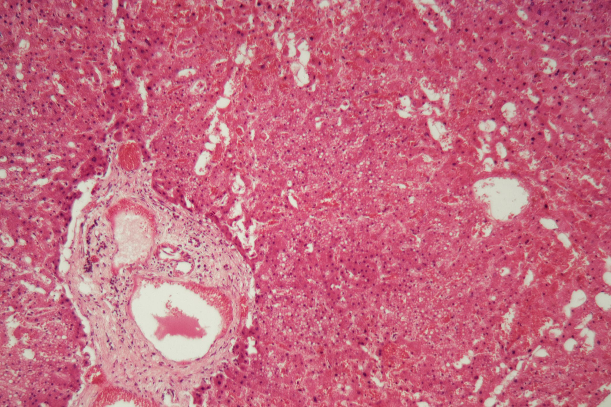 Human liver tissue with Amyloidosis under a microscope.