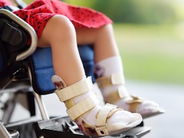 In the past, clinics have diagnosed CP in children with muscle tightness or developmental delay. cerebral palsy girl