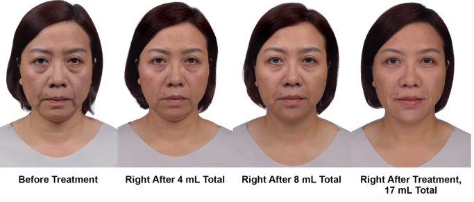  Fifty-three-year-old woman before and after treatment following MD Codes. (SpringerLink)
