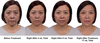 Photo of woman before and after using MD Codes for botox injections