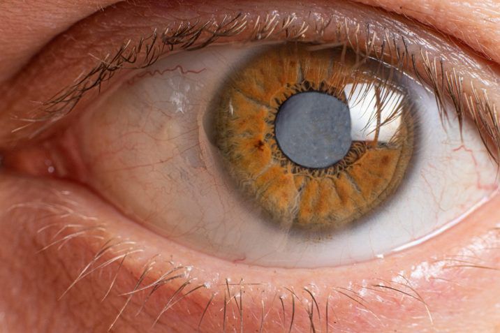 Cataracts affect more than 24.4 million people in the U.S. 40 and older, and about half of those by age 75.