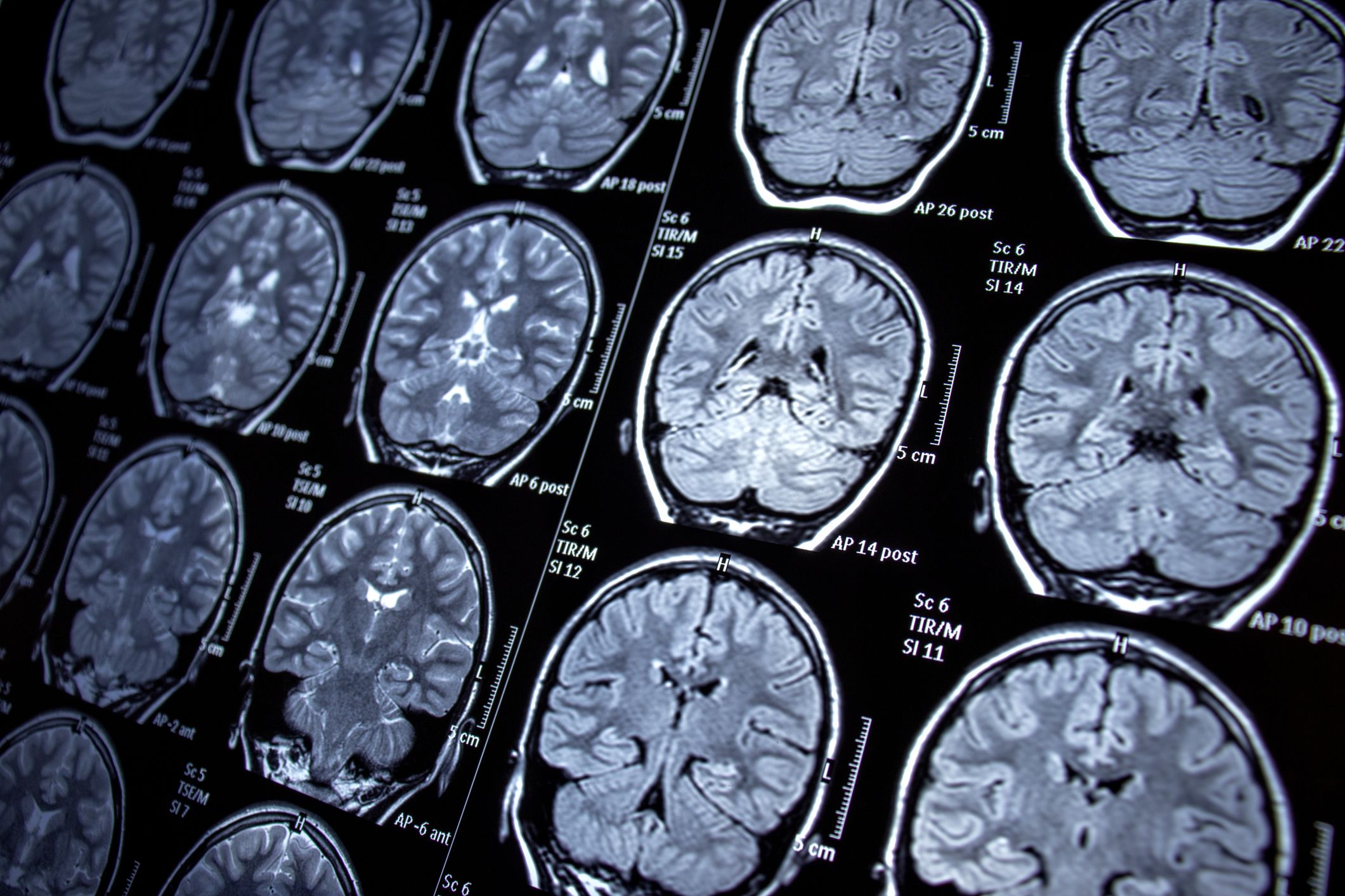 Recent research pointing to a relationship between hormonal therapy and meningiomas prompted the further investigation. GETTY
