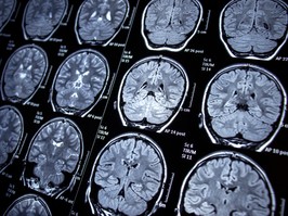 Magnetic resonance imaging - MRI - Photosensitive Epilepsy / Seizures - Neurological Diseases