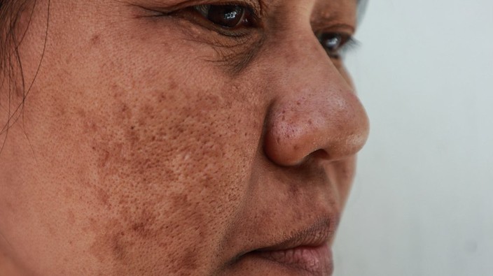 Melasma: The emotional impact of skin disease