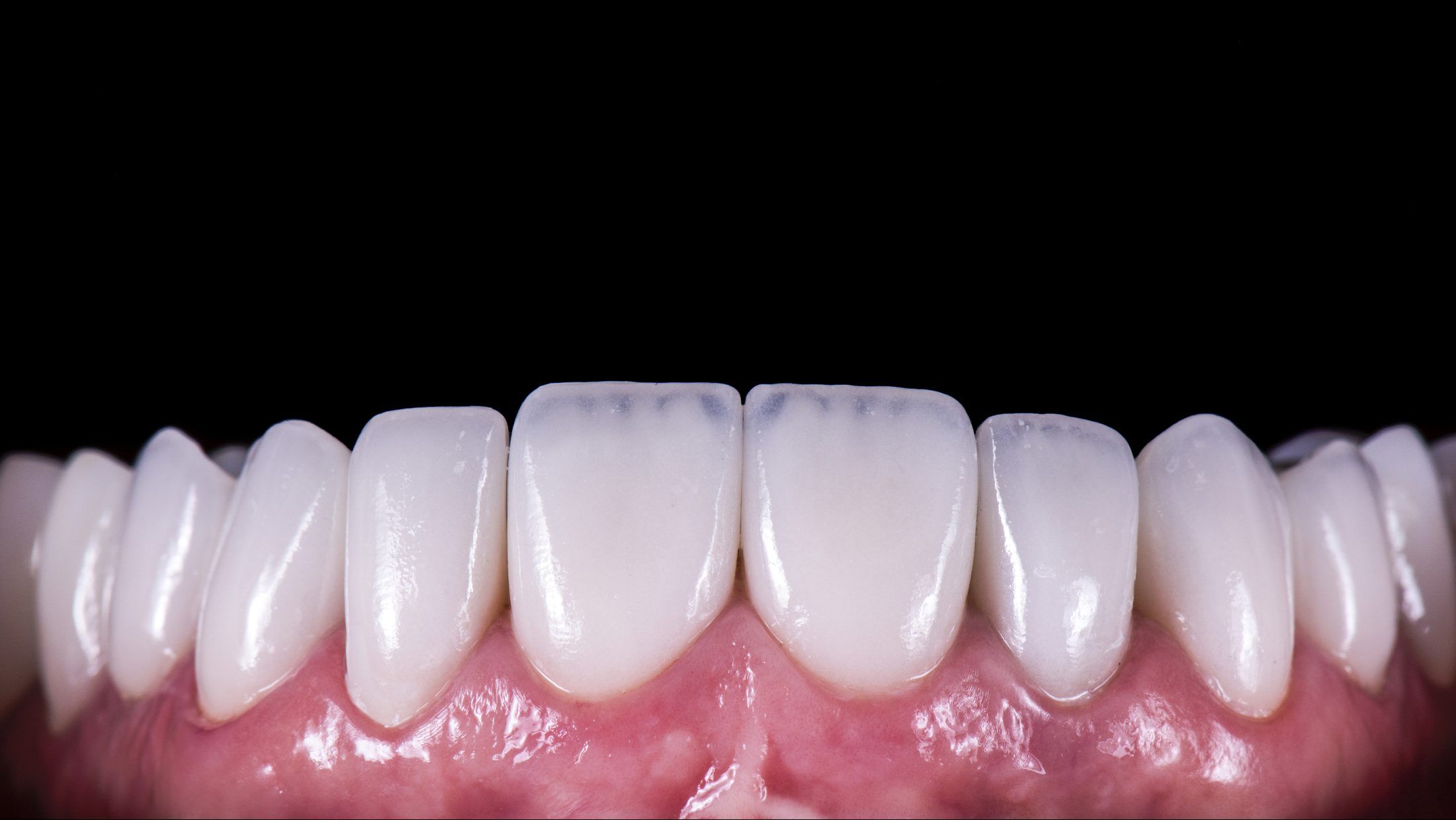 The cost of veneers depend on the dentist, the state of the tooth, and the material chosen for the veneer itself. GETTY