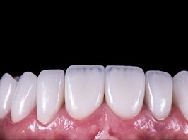 press ceramic veneers b2 color