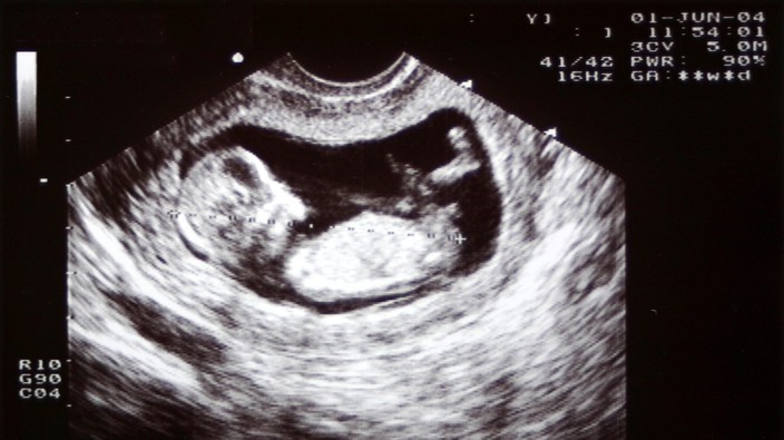 Boys more likely to experience complications in the womb than girls