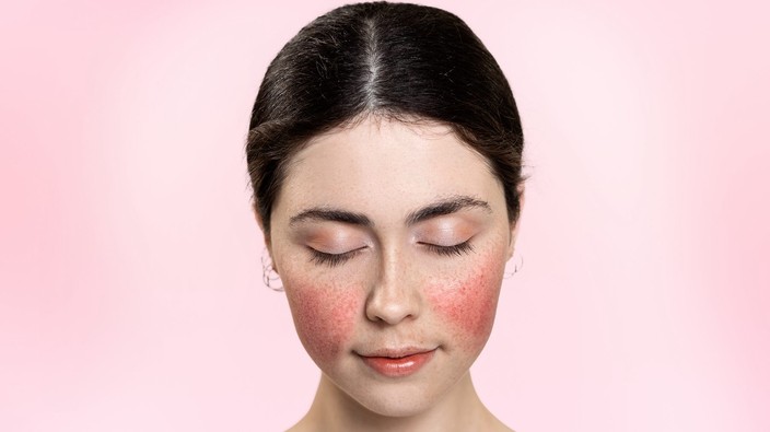 Is there a way to take the red out of rosacea?