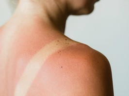 Close-up of a sunburn marks on a woman's back