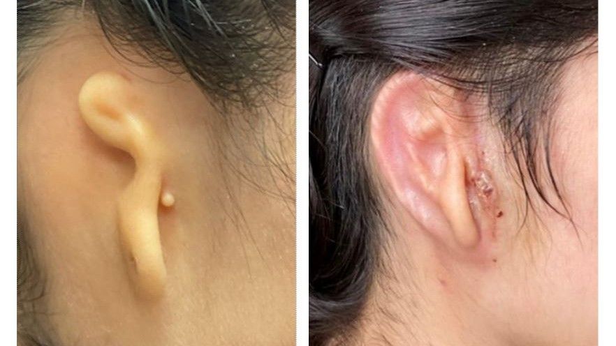 Left: The patient's ear before surgery. Right: The patient's ear 30 days post-surgery. Photo provided by Dr. Arturo Bonilla courtesy of 3DBio Therapeutics.