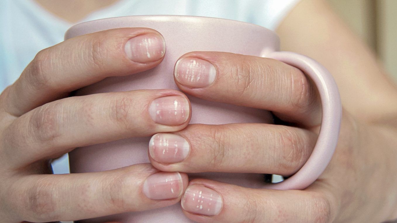 Leukonychia is a condition that refers to the little white spots or lines on your fingernails. GETTY