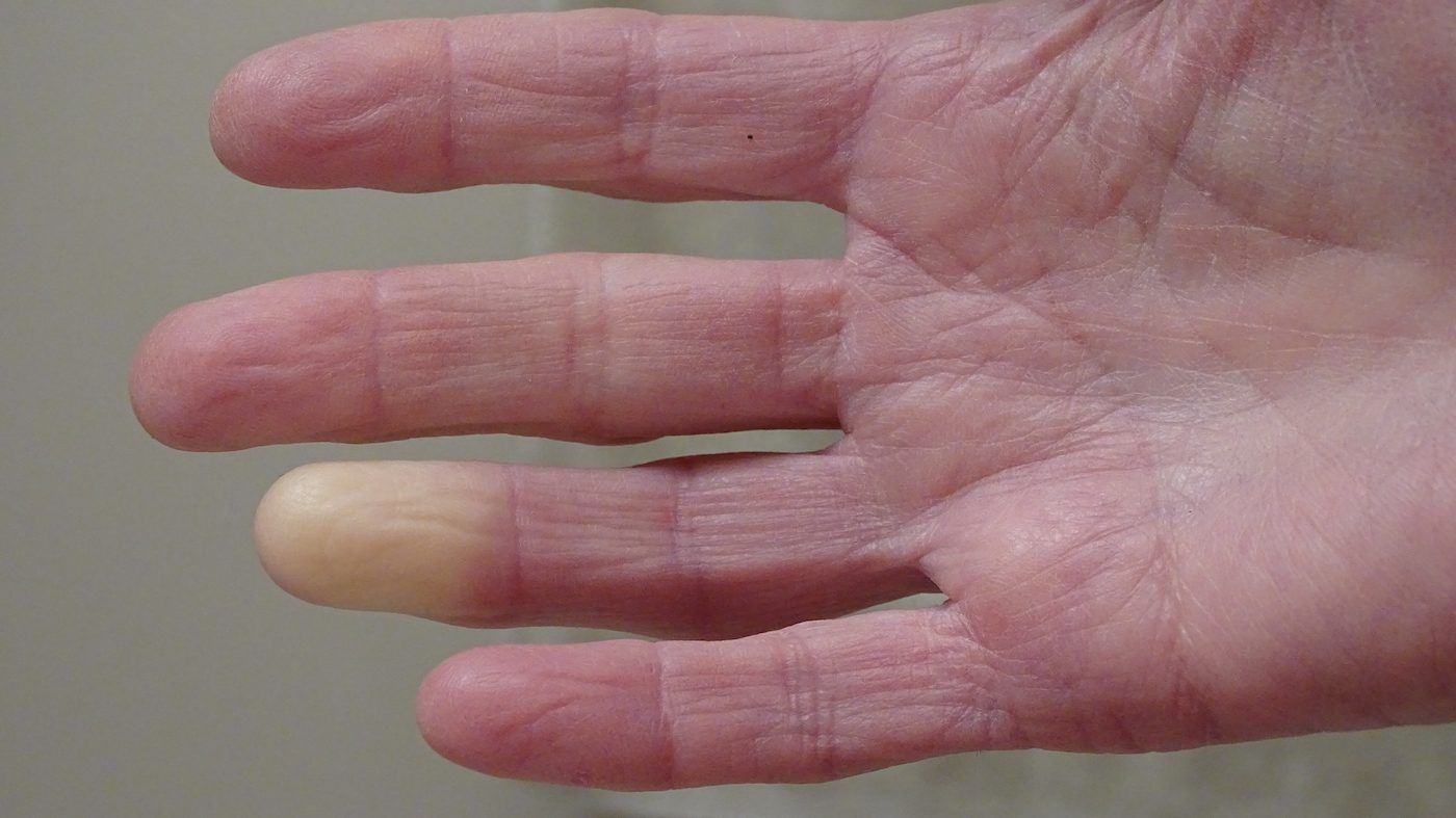 For many patients, the first sign of scleroderma is a temporary decrease in the size of the blood vessels in the fingers and toes known as Raynaud’s phenomenon. GETTY