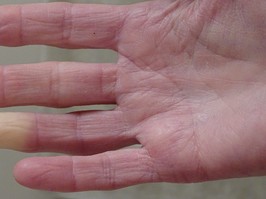 Raynaud’s phenomenon