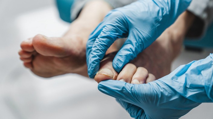 Nail Fungus and Onychomycosis: Prevention, Symptoms, and Treatment