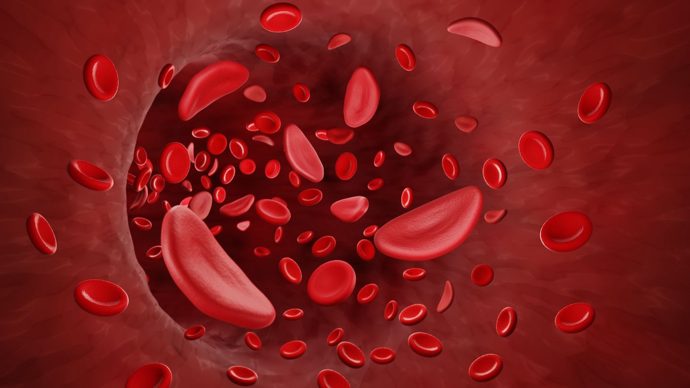 Sickle cell disease is typically diagnosed as part of routine blood testing at the time of birth. GETTY
