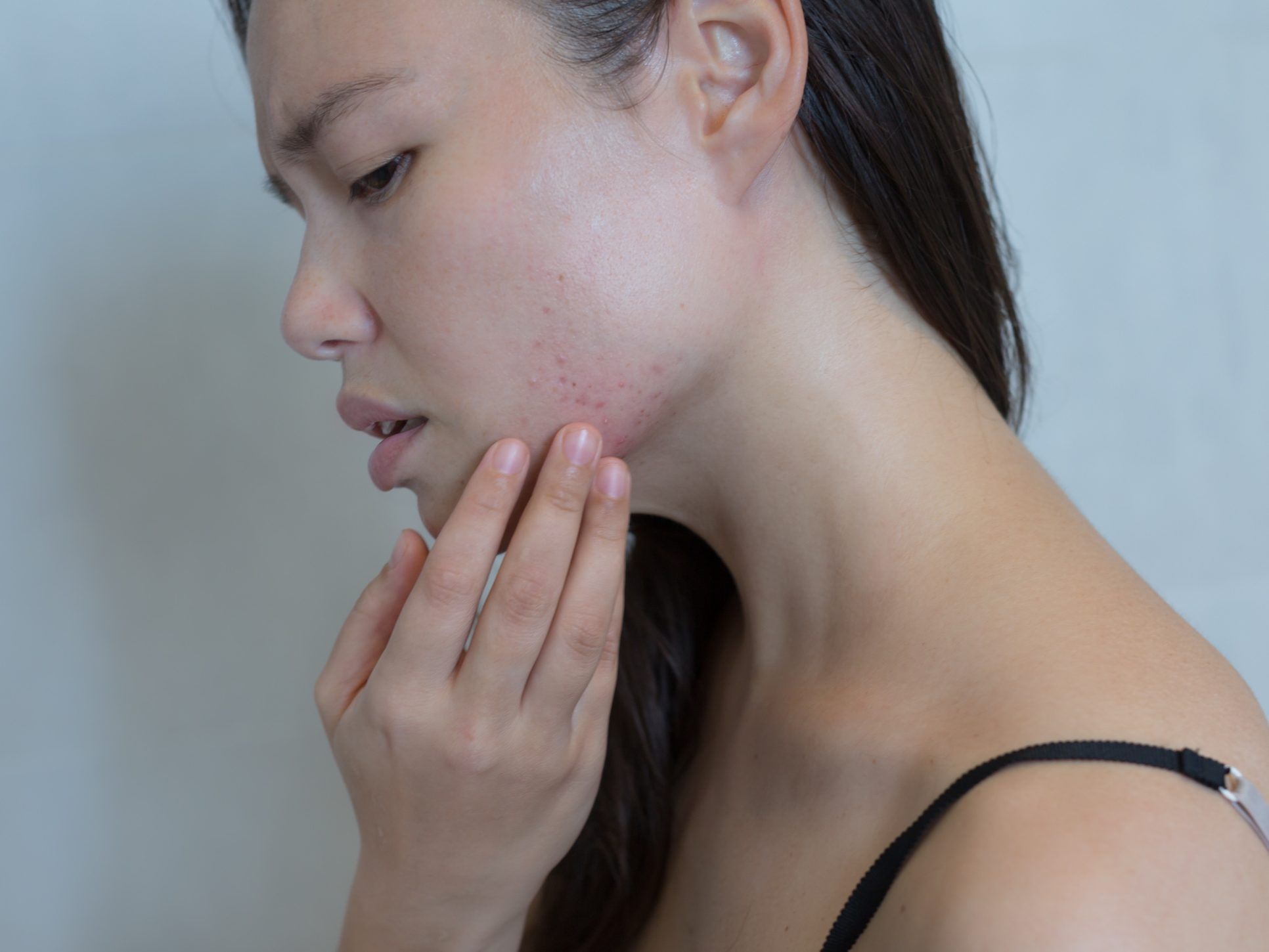 A woman touching her pimples on her cheeks with a worried expression.