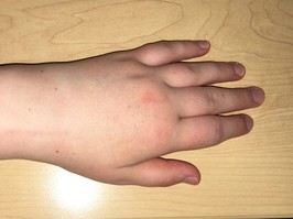 Rachel Gehue - swollen hand