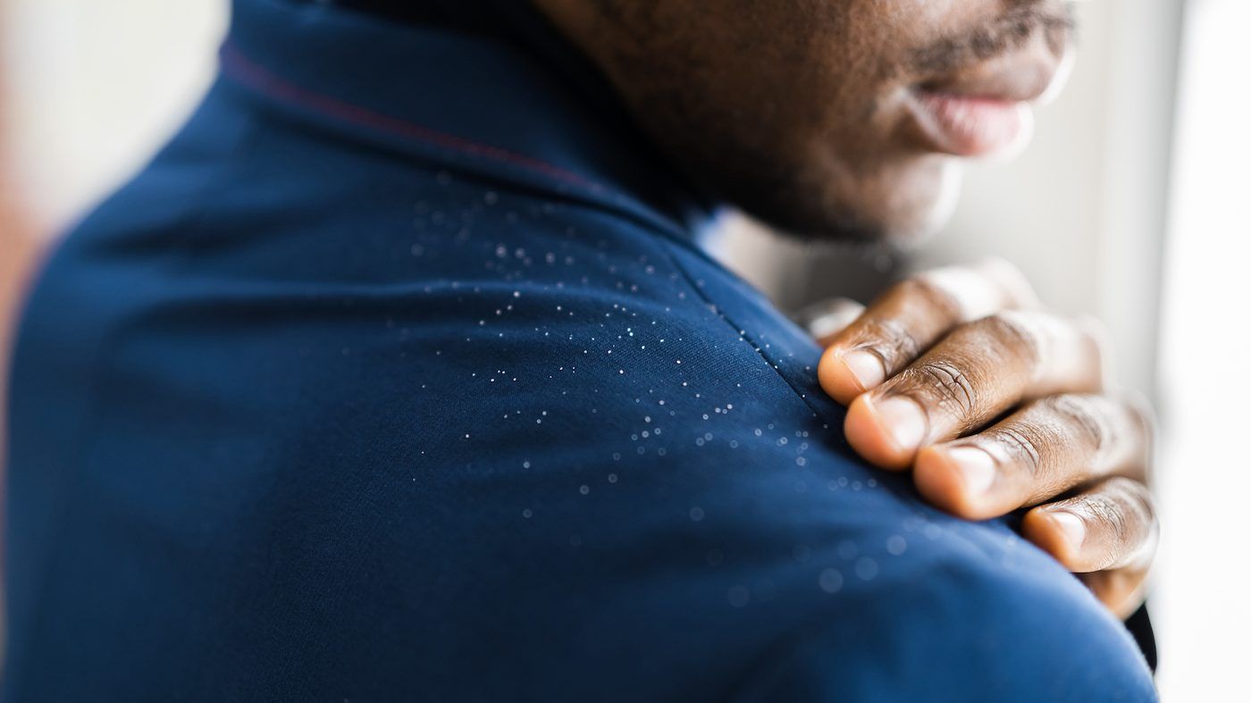 dandruff, which is basically flakes of skin, is usually harmless and affects about one in five canadians. getty