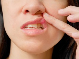 Canker sore on woman upper lip