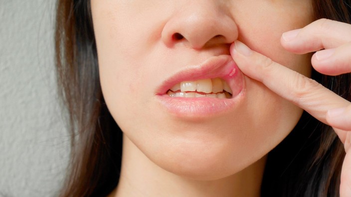 Is there a way to prevent the pain of canker sores?