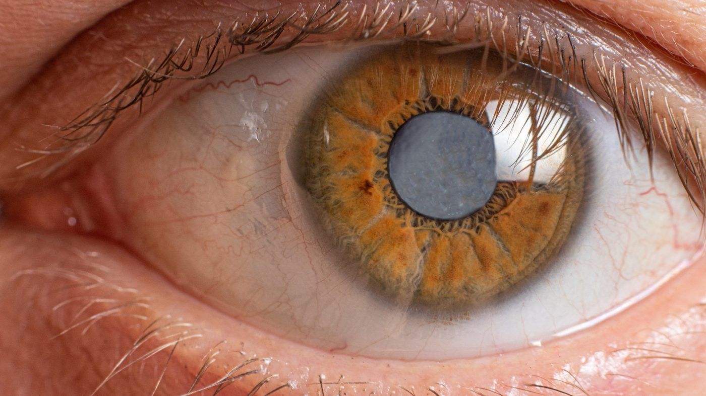 Symptoms of cataracts include double or cloudy vision. GETTY