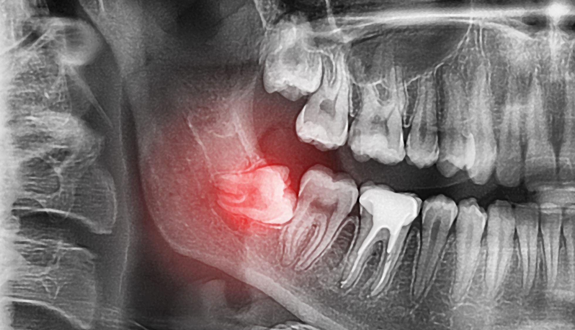 one study found that around 53 per cent of people aged 25 and older have had at least one wisdom tooth grow in. getty