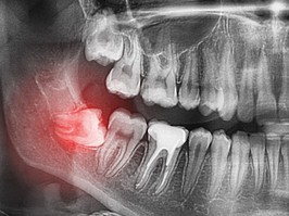 radiographs of the wisdom teeth