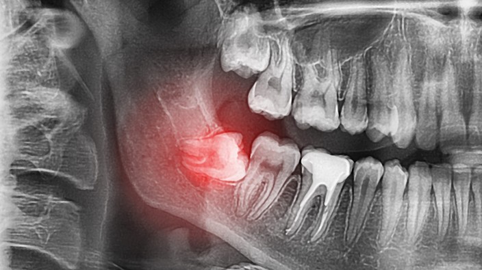 Do wisdom teeth serve any other purpose than causing pain?