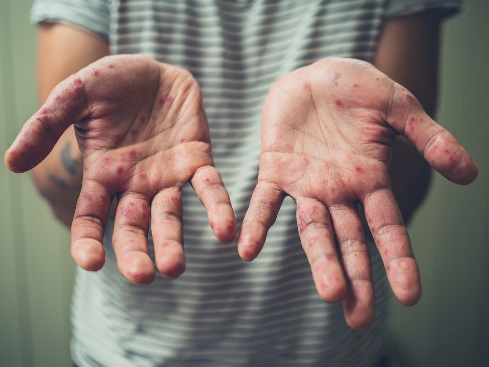 a young man is showing his hands with spots and rash from hand foot and mouth disease.