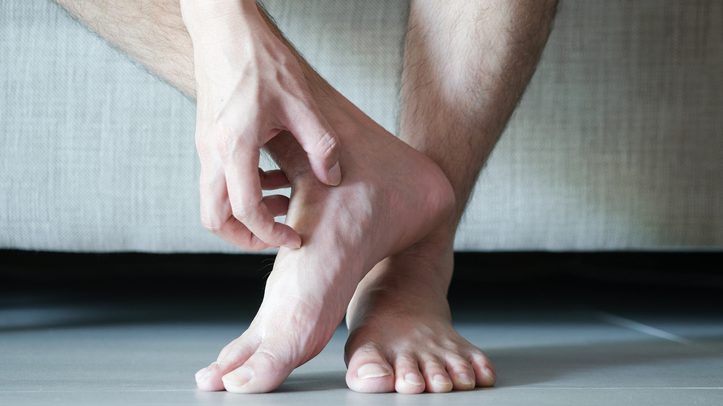 The condition typically occurs in people who are prone to sweaty feet. GETTY