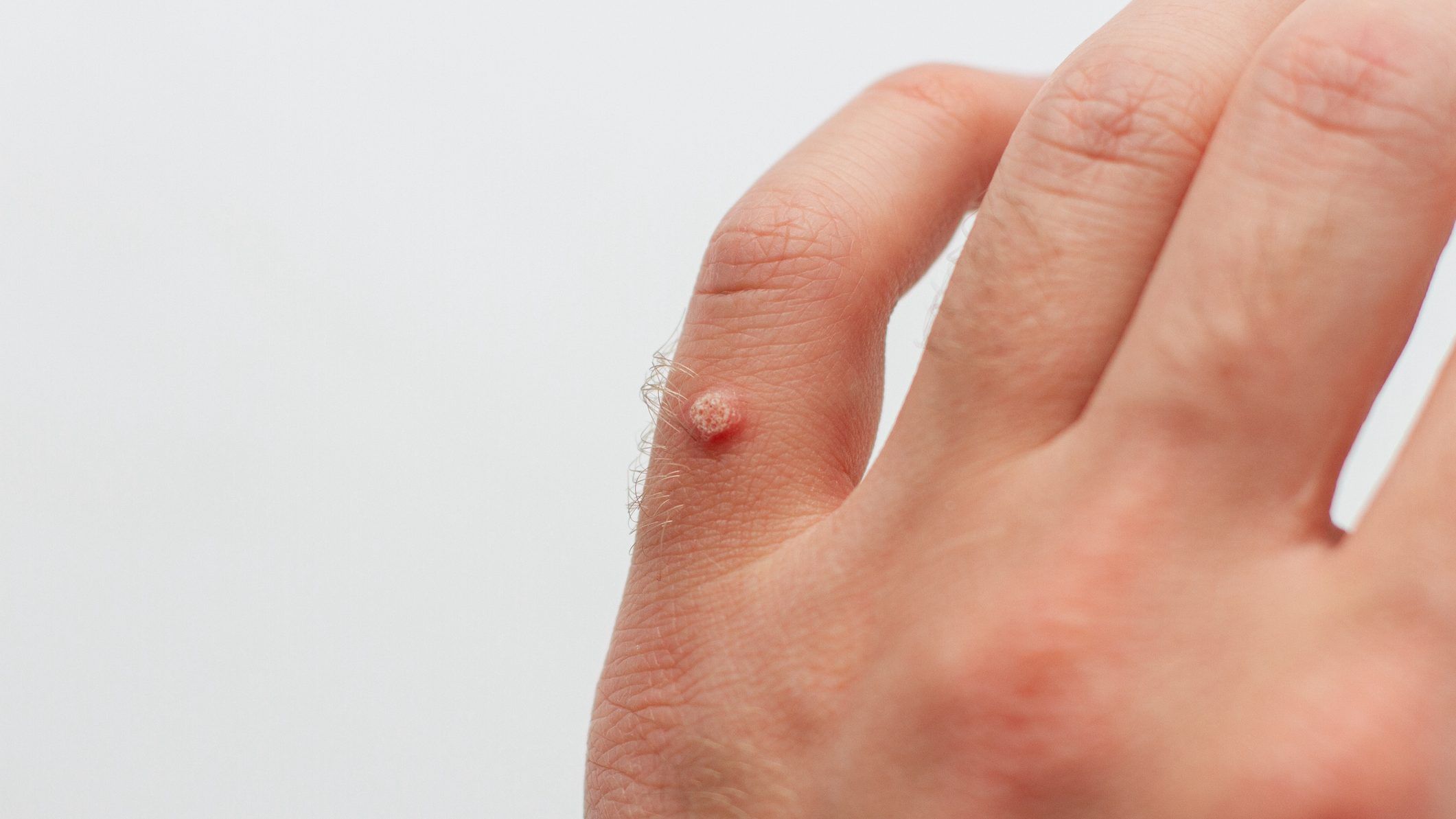 The best prevention for warts is to treat new ones as soon as they appear. GETTY