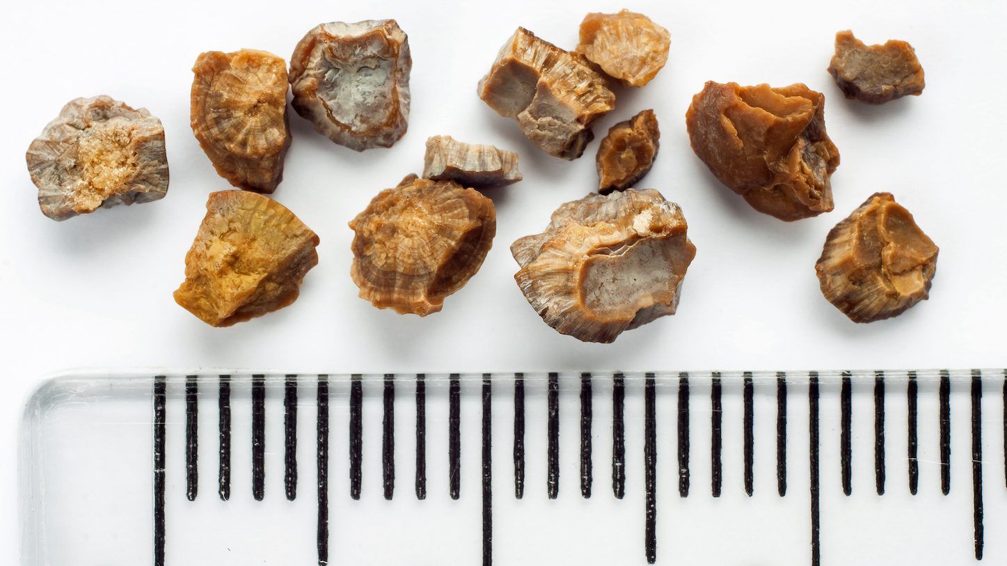 Around 12 per cent of Canadian men — and six per cent of women — will develop a kidney stone at some point in their lives. GETTY