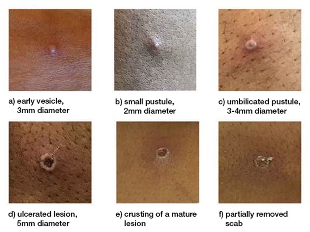 the different stages of a monkeypox skin lesion.