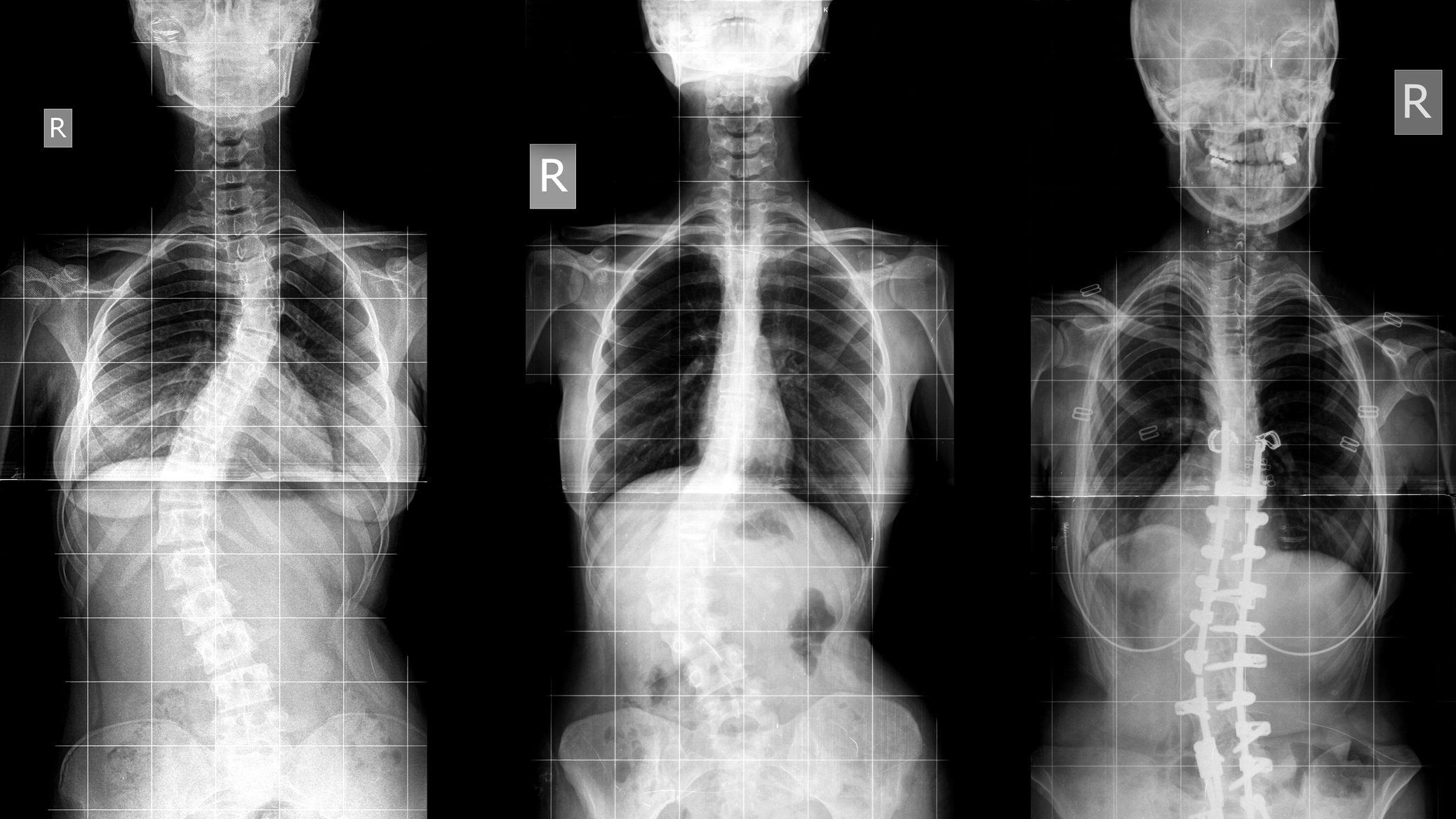While most instances of scoliosis are mild, severe cases can cause the rib cage to press against the lungs, making it difficult to breathe. GETTY