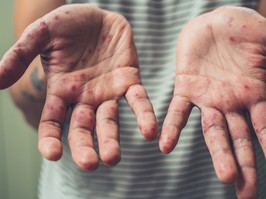 Boy with hand foot and mouth disease